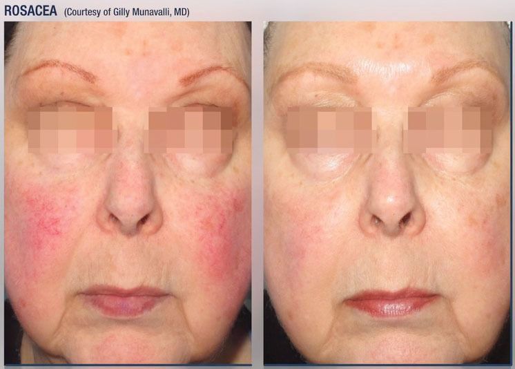 patient at barber facial plastic surgery before and after photofractional laser treatment for rosacea