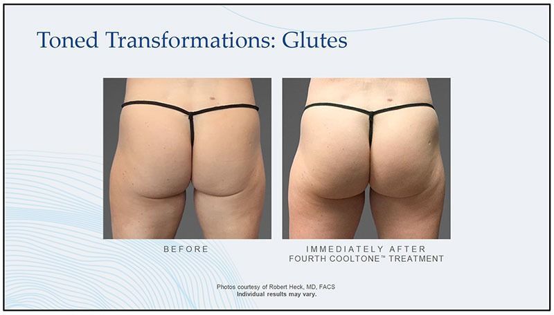 cooltone patient before and after treatment - glutes
