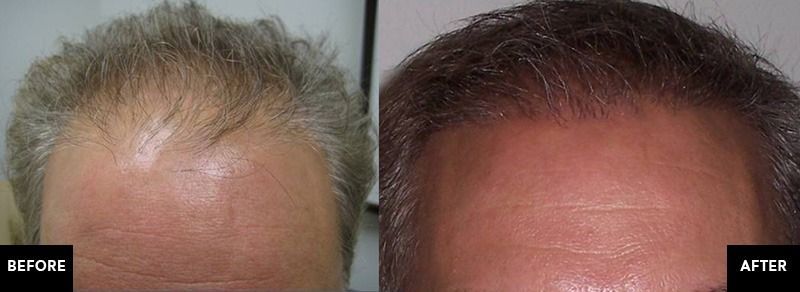 patient before and after neograft hair restoration treatment mobile al