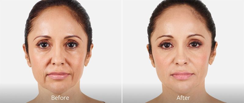 patient before and after juvedern fillers 