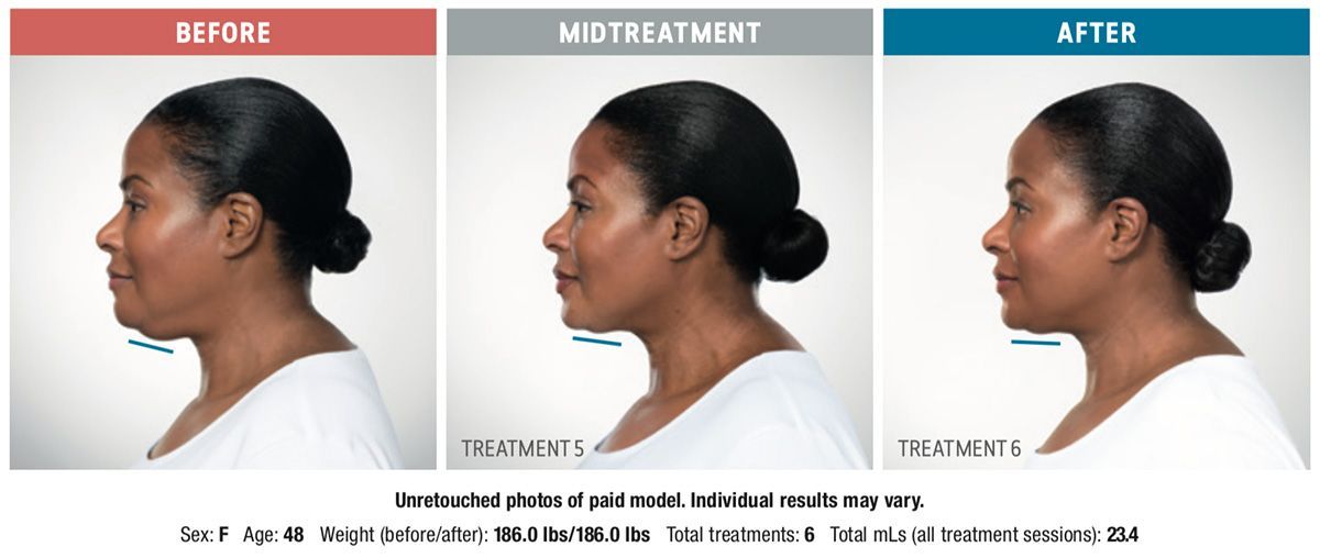 patient before and after Kybella for double chin injectable