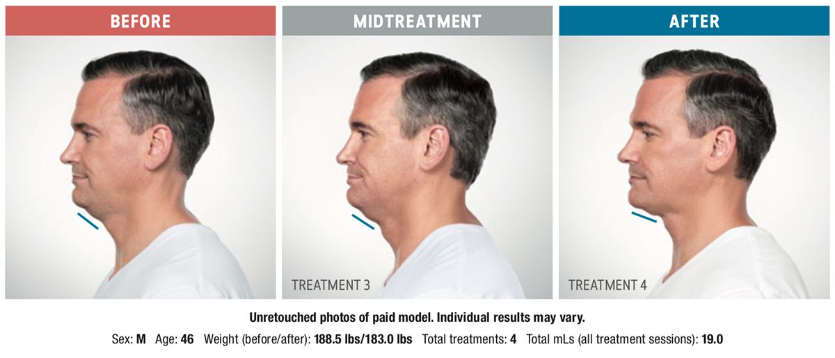 patient before and after Kybella for double chin injectable