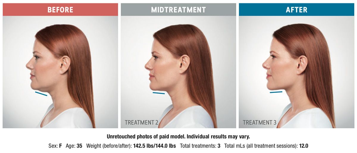 patient before and after Kybella for double chin injectable