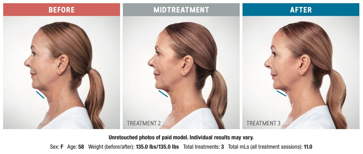 Three side-by-side profile photos labeled Before, Midtreatment, and After, showing a woman’s jawline progression