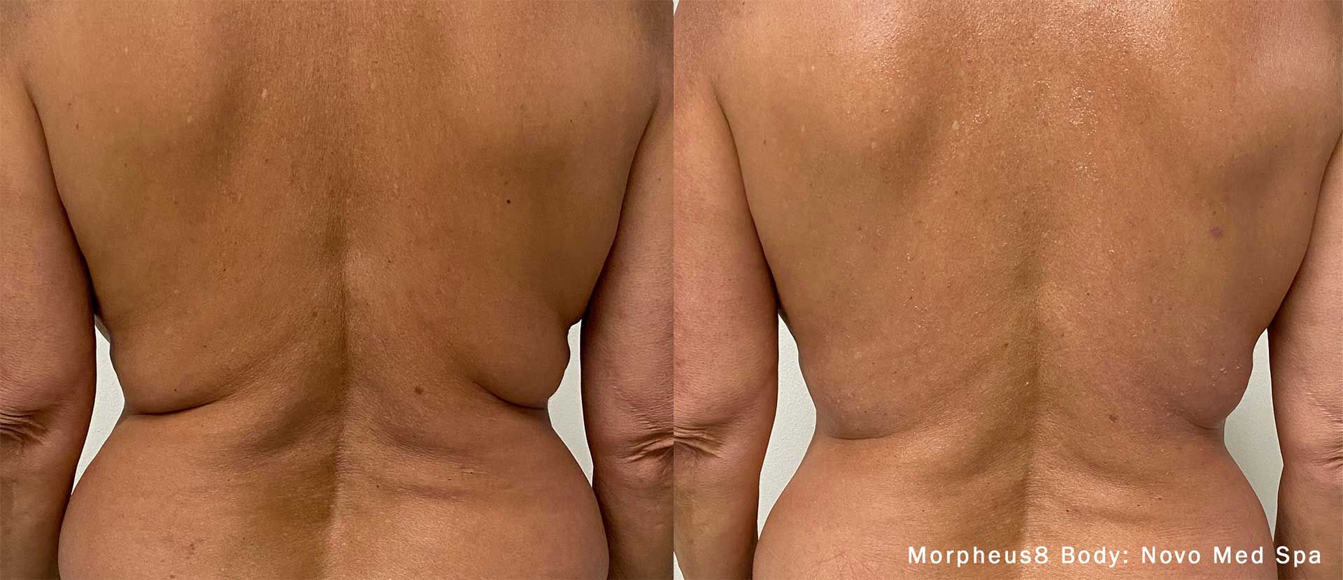 morpheus8 body - patient before and after treatment - lower back