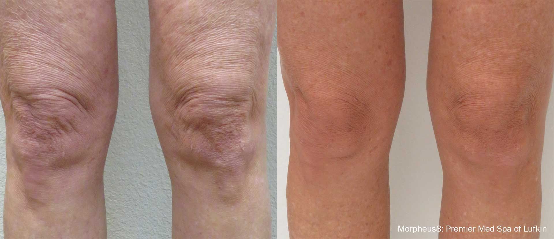 morpheus8 body - patient before and after treatment -legs