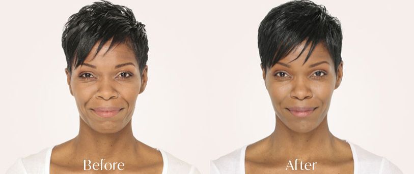 patient before and after juvederm fillers 