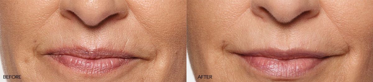 patient before and after restylane fillers 