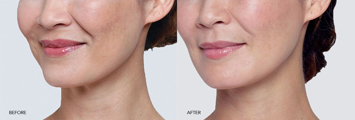 patient before and after juvederm fillers