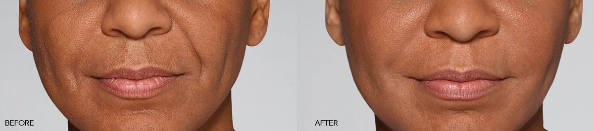 patient before and after restylane fillers 