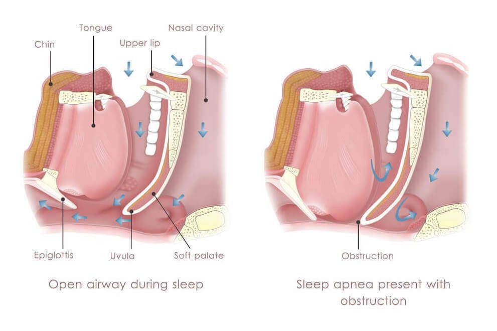 sleep apnea Infographic