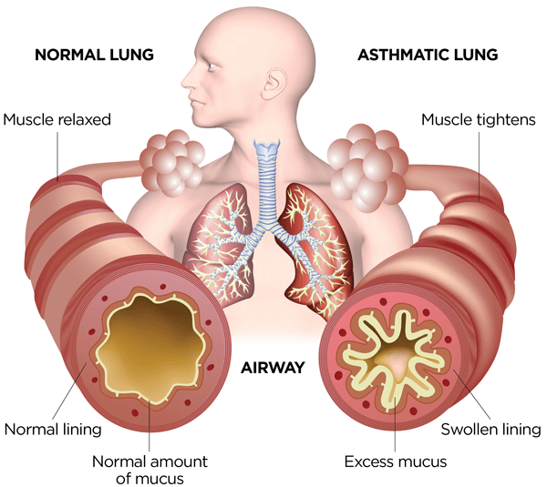 asthma inforgraphic