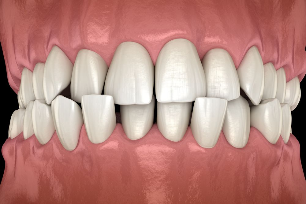 Close-up of human teeth, showing the upper and lower arches. Teeth are white and slightly misaligned.