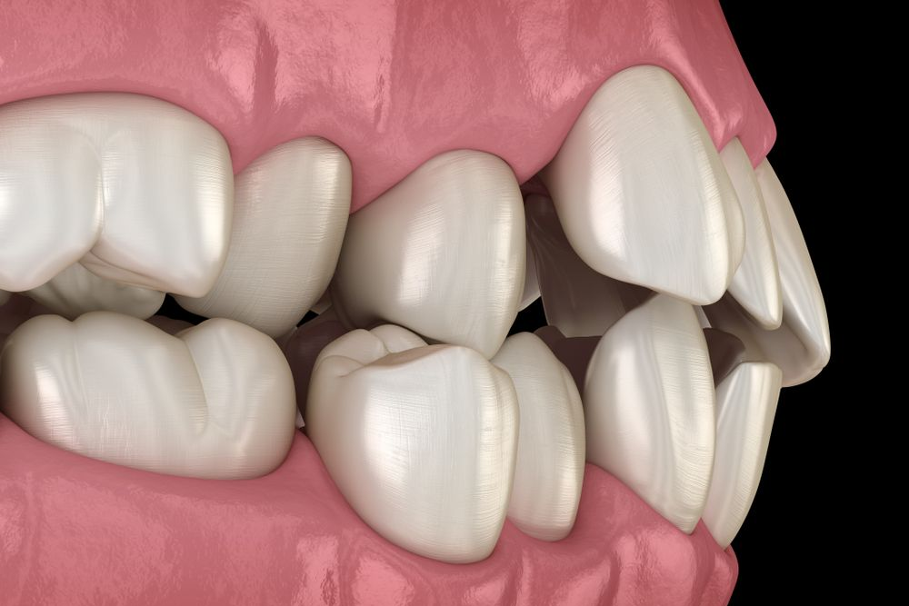 Side view of human teeth showing crowded and misaligned teeth.