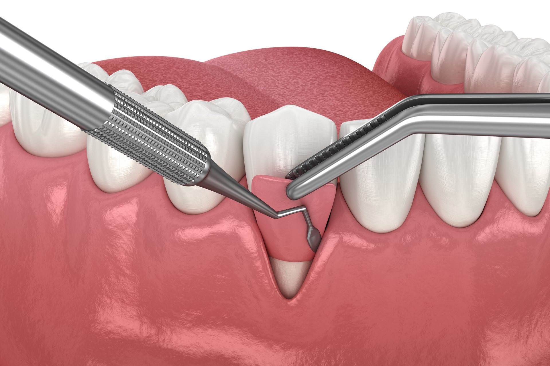 Dental instruments performing a gum graft procedure on a tooth, with red gum tissue and white teeth.
