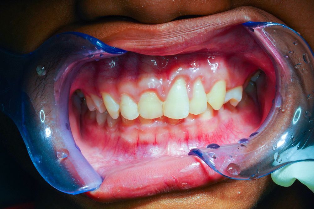 Mouth held open with blue retractor, revealing teeth and gums.
