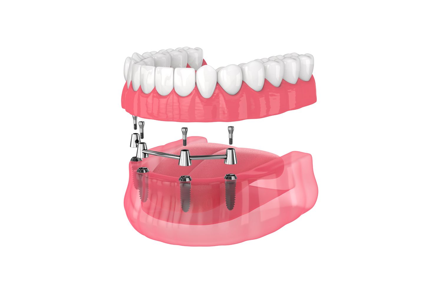 Upper denture with two metal posts, pink gums, and light-colored teeth, isolated on white.