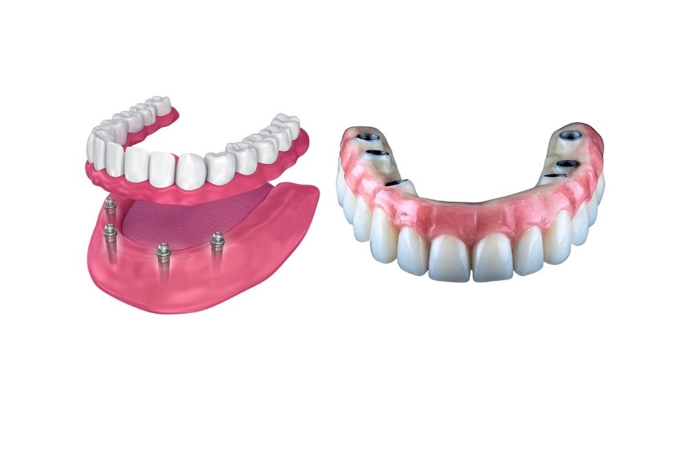 Two sets of dentures with implants; one set separated, the other intact. Pink gums, white teeth.