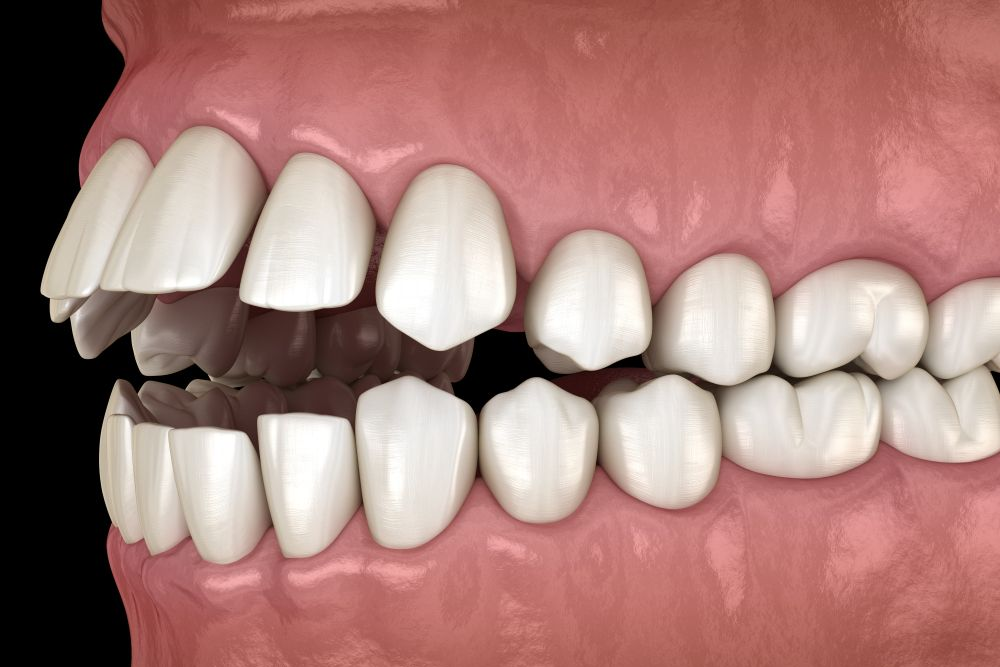 Side view of teeth with a significant overbite and crowding.