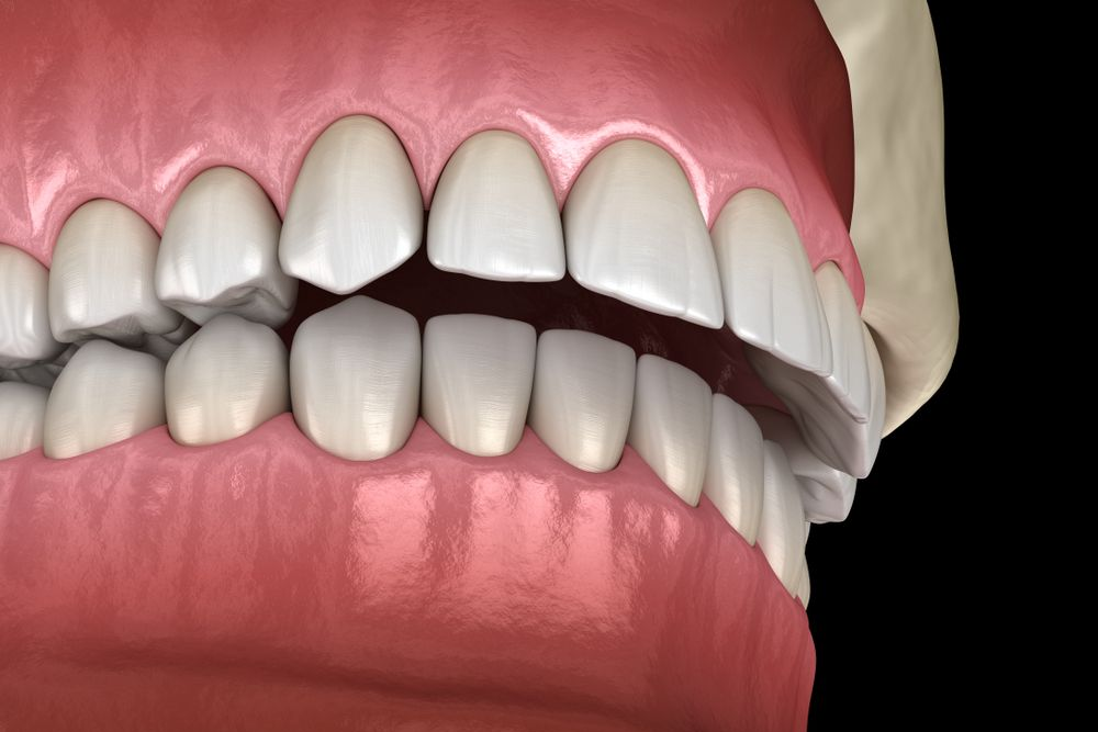 Teeth with an overbite, showing misaligned upper and lower teeth. Pink gums, white teeth.