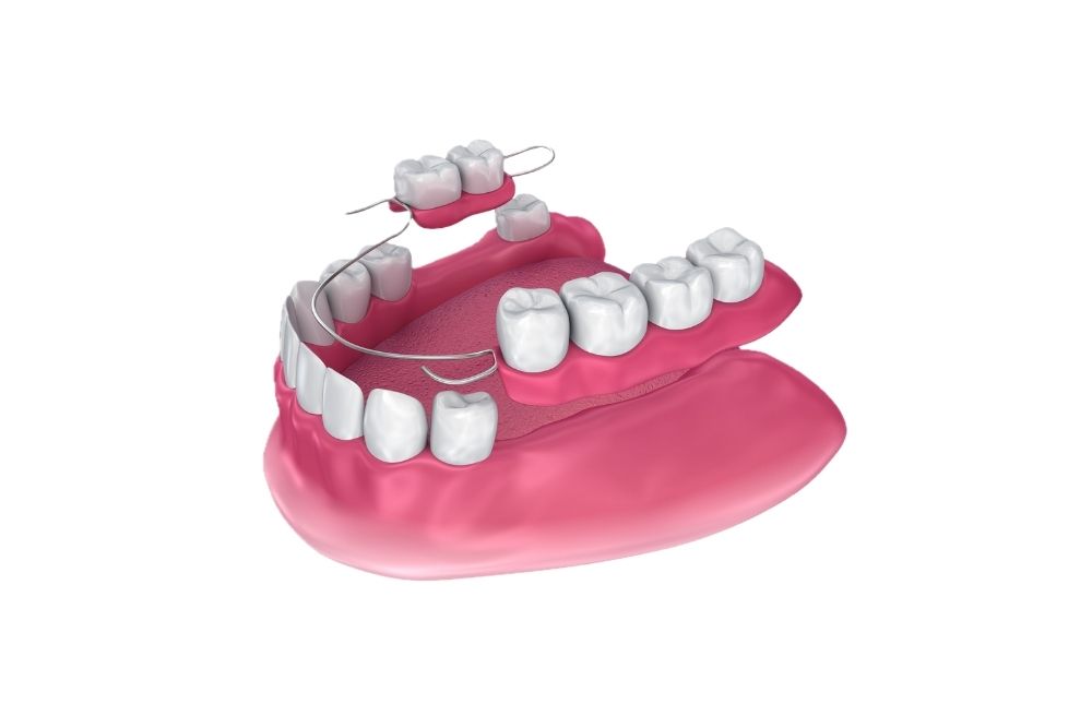 A partial denture with artificial teeth and wire framework, in pink gum, on white background.