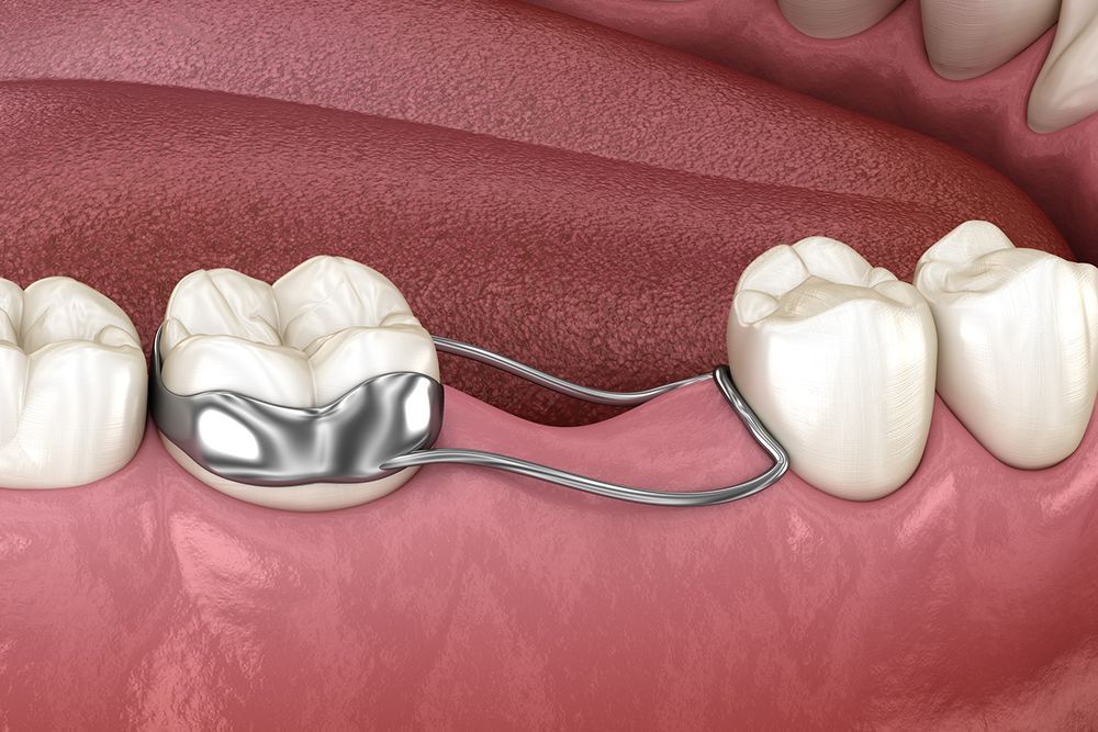 Dental model showing a space maintainer with a metal band and wire arch.
