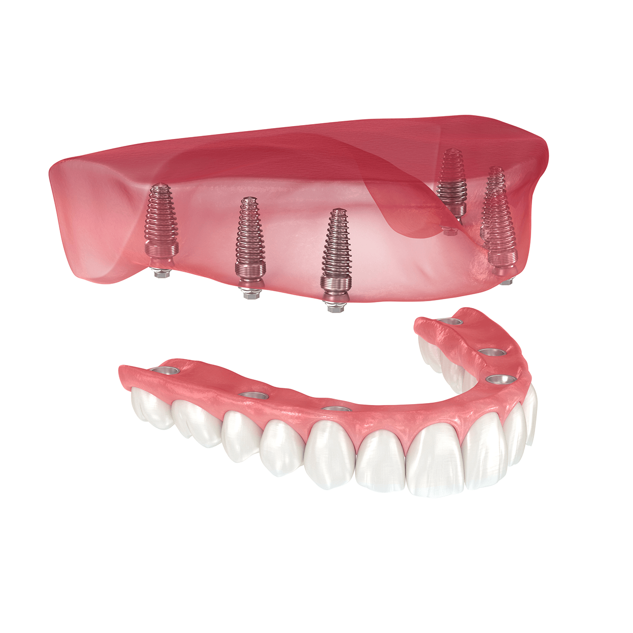 Example of permanent dentures in Mount Pleasant, SC