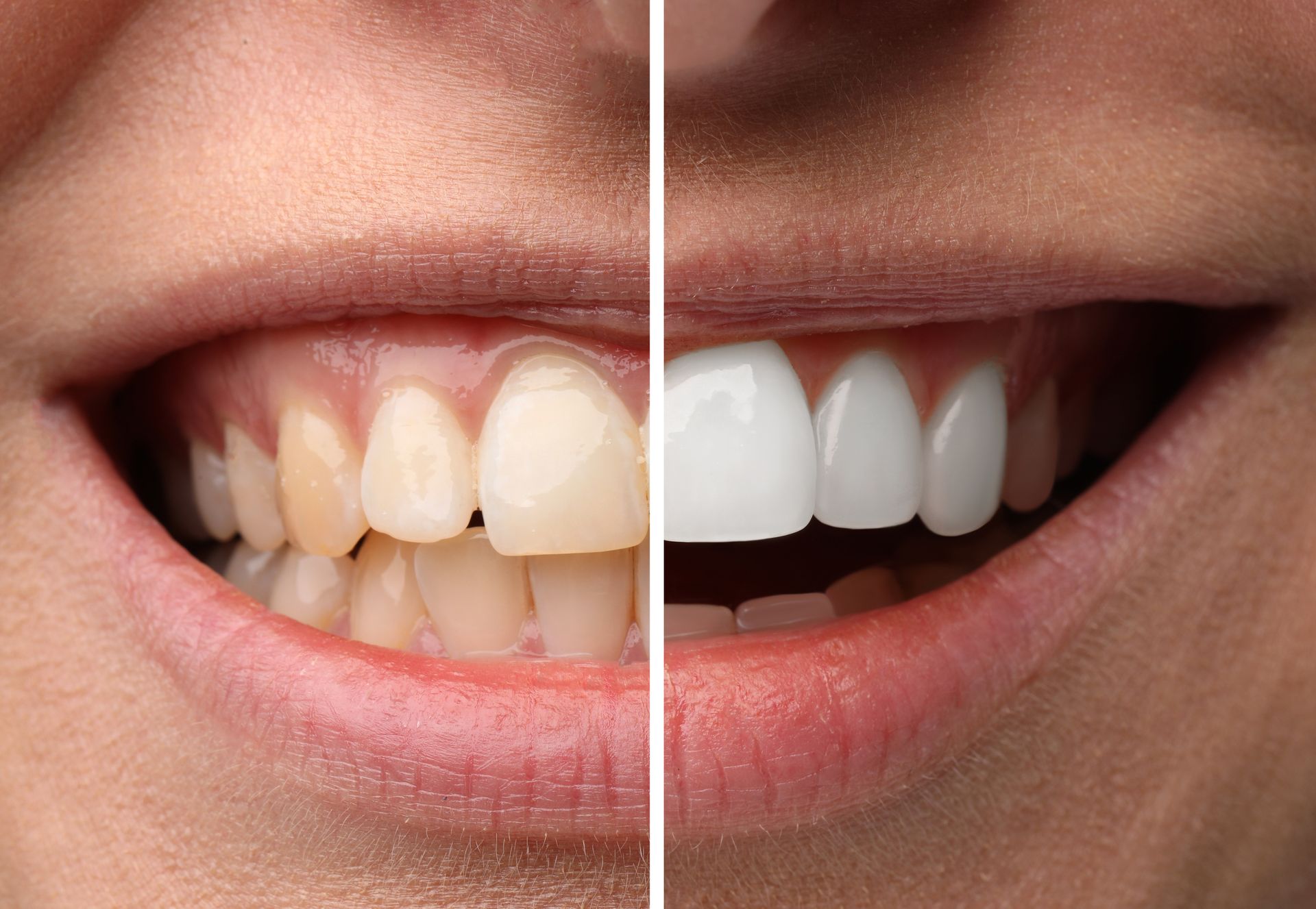 Split image showing discolored teeth on one side and bright, whitened teeth on the other.
