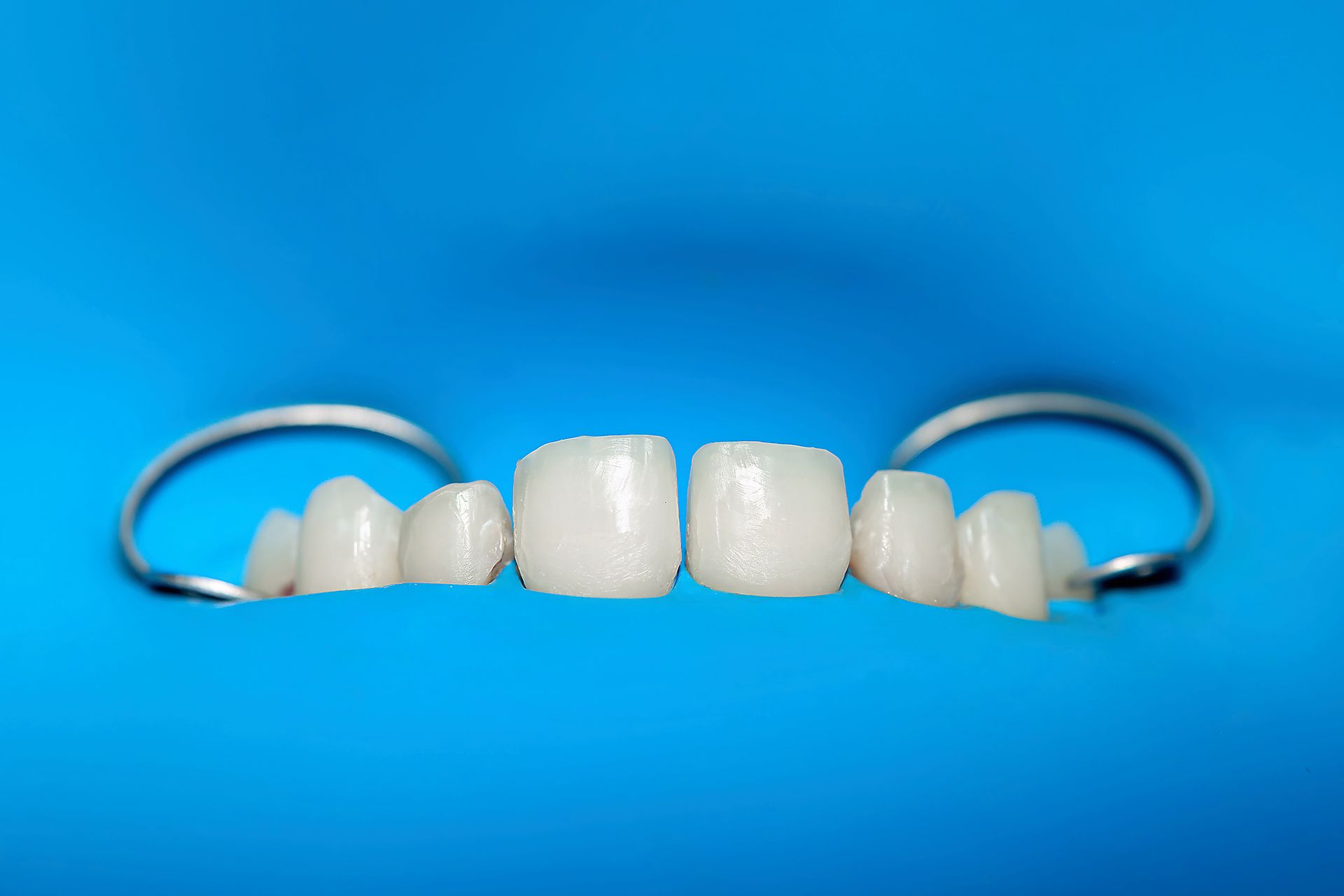 Row of dental veneers displayed on a blue background with metal tools beside them.
