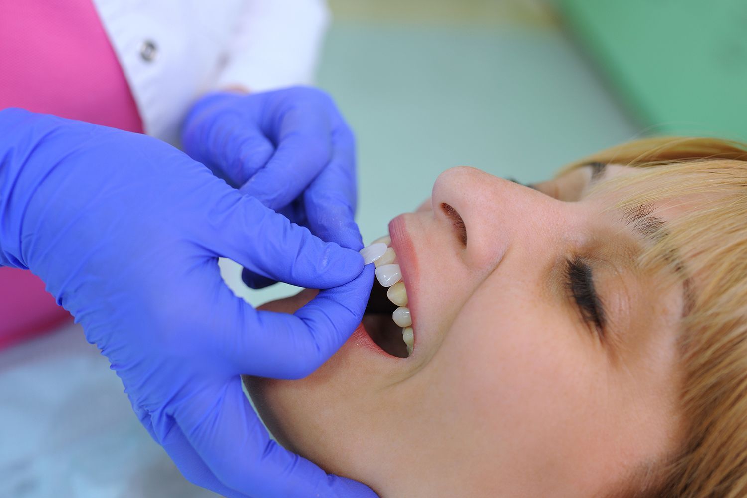 A cosmetic dentist, wearing blue gloves, tries on dental veneers on a patient for teeth correction.