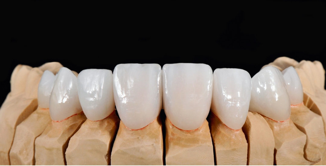 Row of dental veneers displayed on a blue background with metal tools beside them.