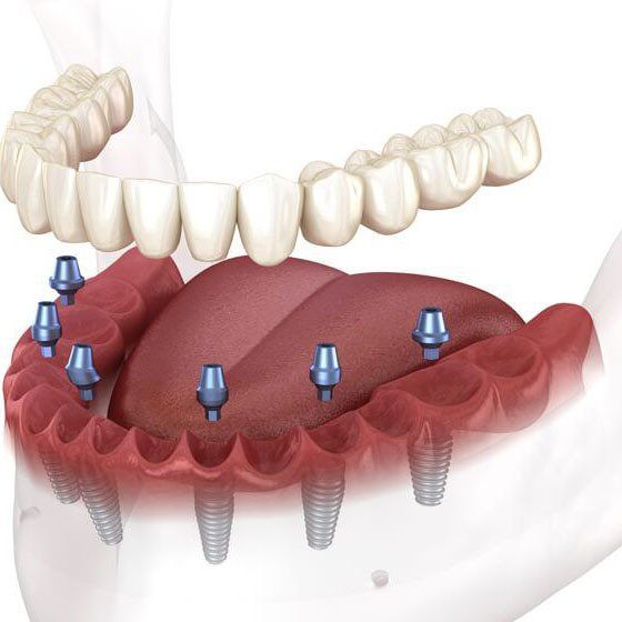 Multiple Teeth Implant – Mt. Pleasant, SC – Smiles by Hogan