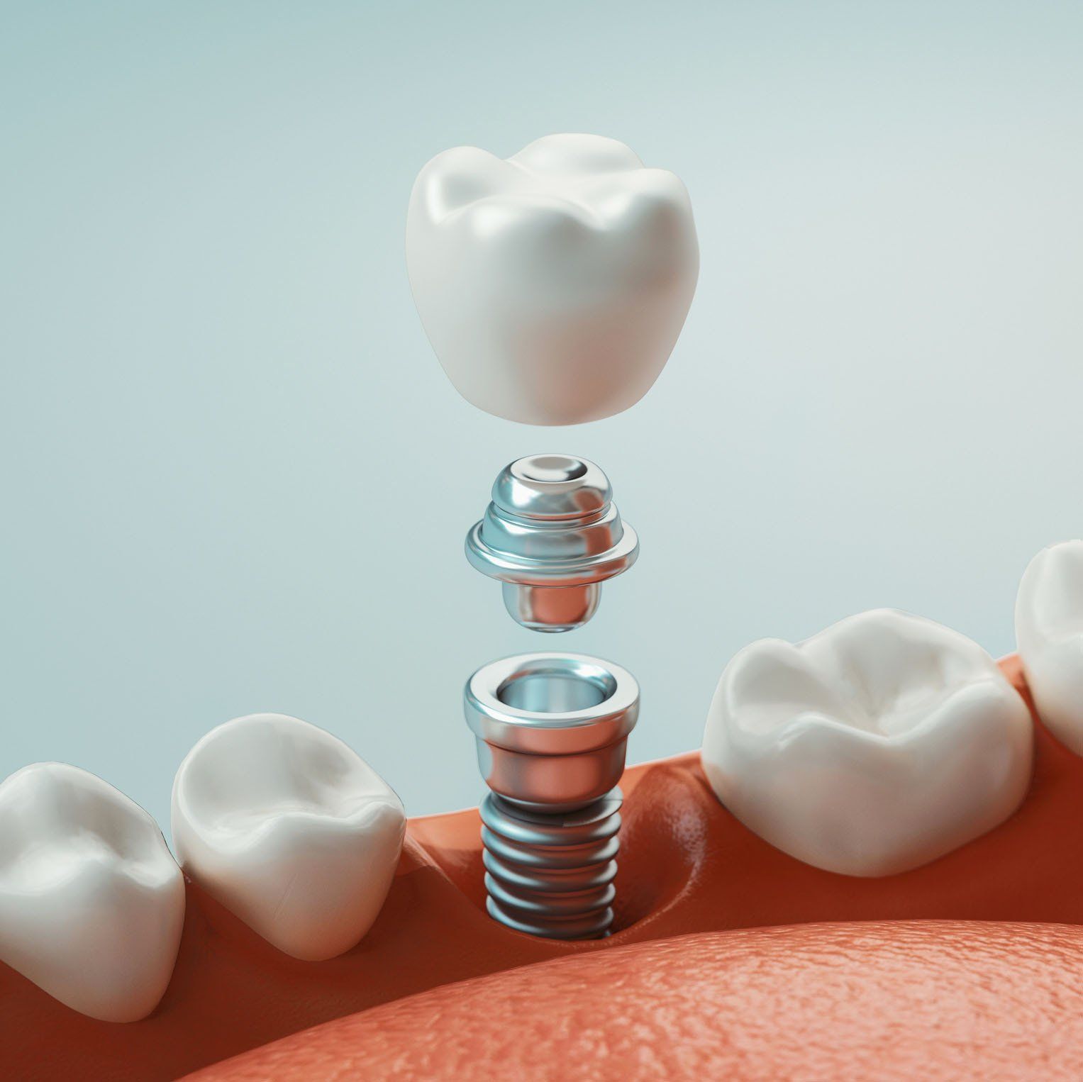 A dental implant procedure being done in Mount Pleasant, SC