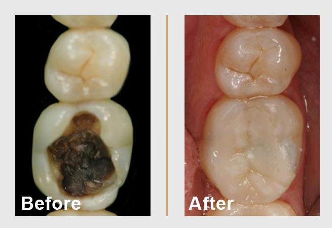 Dental images show a tooth before and after a filling. Before shows a large cavity, after shows the filled tooth.