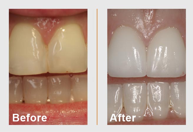 Side-by-side comparison of teeth. Before: stained teeth. After: Bright, white teeth.