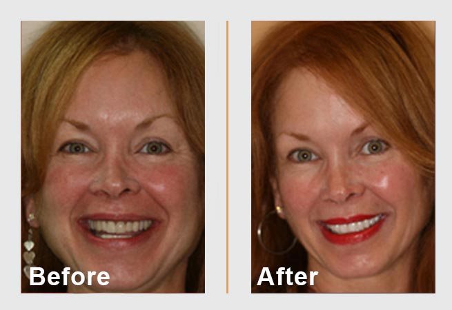 Side-by-side comparison of a woman's smile before and after a cosmetic dental procedure, showing whiter teeth.