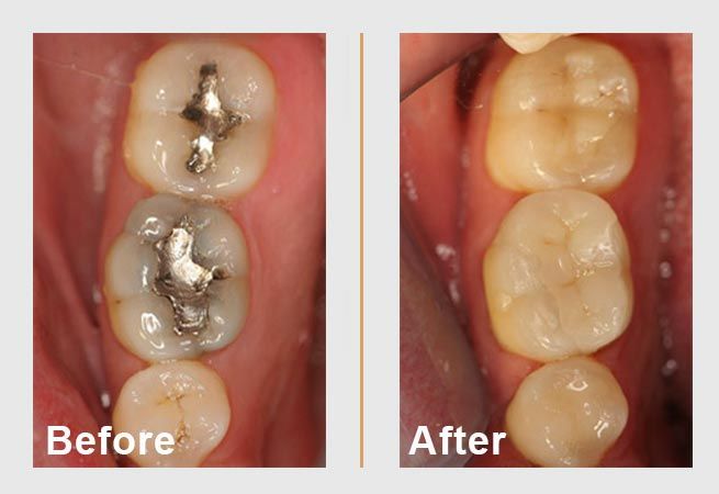 Before and after dental images of teeth with silver fillings replaced by tooth-colored fillings.