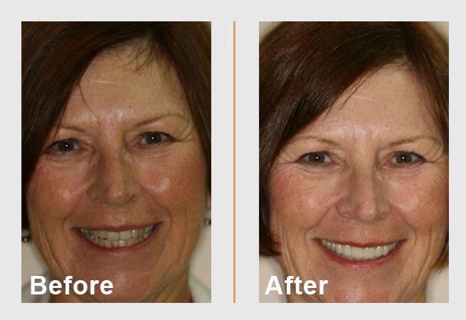 Before-and-after of a smiling person's teeth. Before shows crooked teeth, after displays a perfect smile.