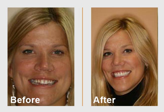 Woman's smile transformation: 