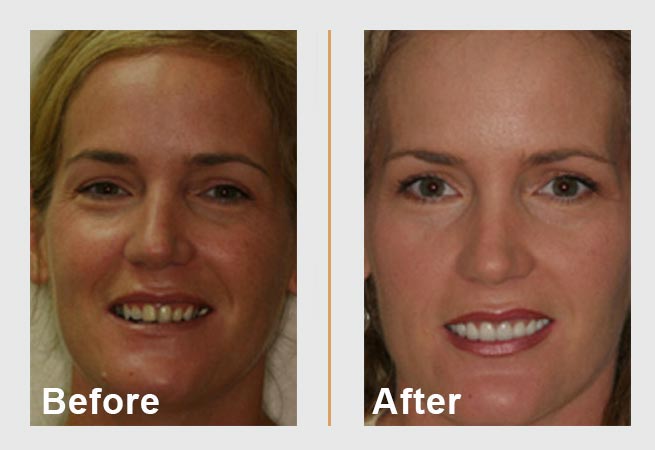 Before-and-after of a person's smile. Before: Visible gaps and discoloration. After: Straight, bright teeth.
