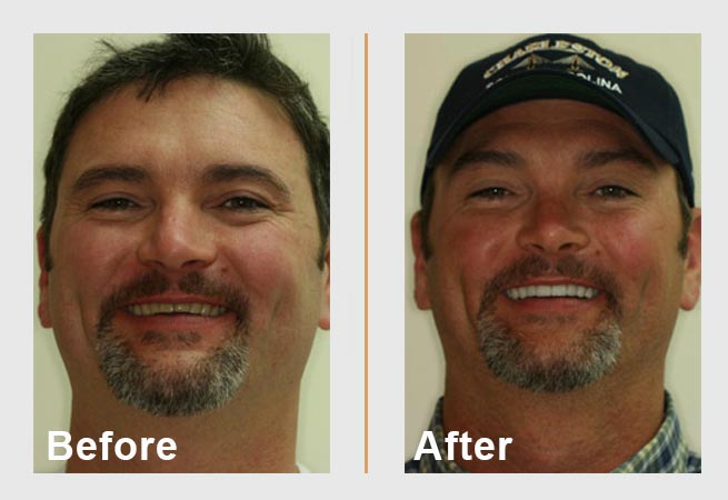 Before and after photos of a man's smile; shows dental work on his teeth, making them brighter.
