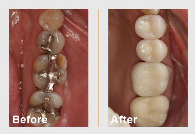 Side-by-side dental comparison: Before with metal fillings, After with white crowns.