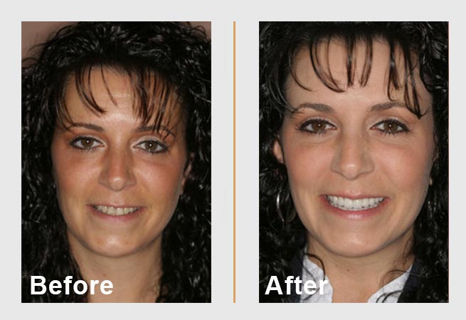 Side-by-side photos of a woman. Before: showing uneven teeth. After: showing a bright, even smile.
