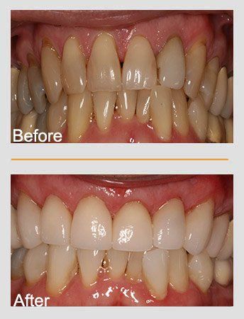 Comparison of teeth, before and after whitening. Yellow teeth improved to white, brighter smile.
