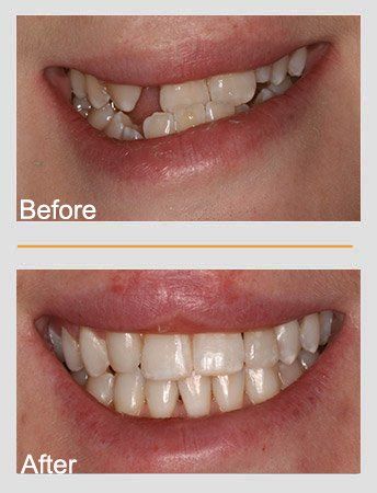 Before and after dental photo: top shows damaged teeth, bottom shows a corrected, healthy smile.