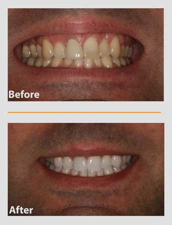 Before and after comparison of teeth whitening: discolored teeth turn white.