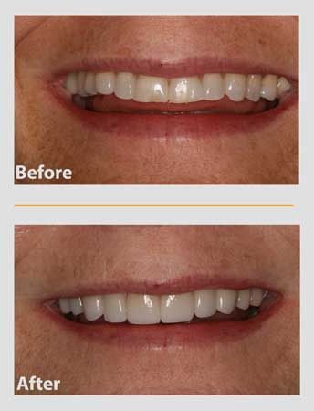 Side-by-side view of a smile before and after dental work, showing whiter and straighter teeth.