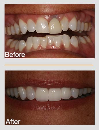 Comparison of teeth before and after dental work; the 