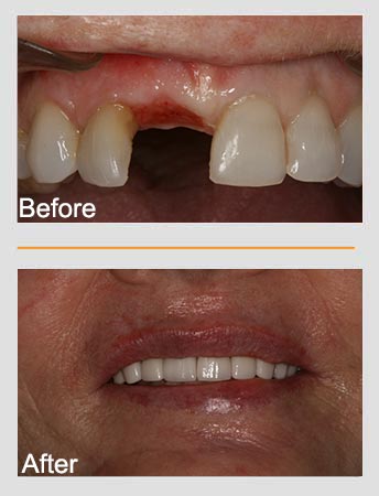 Before and after dental work; missing front tooth replaced, showing improved smile.