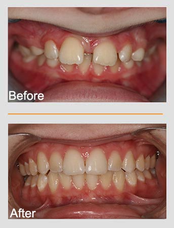 Before and after images of teeth. Top: crooked teeth with a gap. Bottom: Straight, aligned teeth.